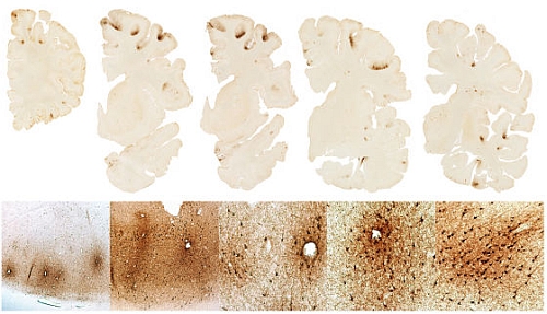 アメフト選手は慢性外傷性脳症になる