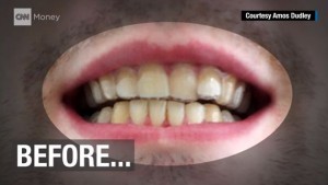 3dprinting-brace-of-teeth-before