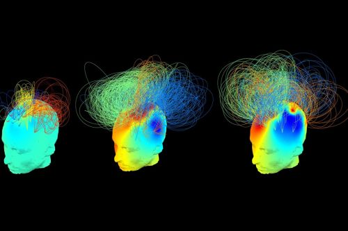 脳波を測定すると植物状態でも意識があるかわかる