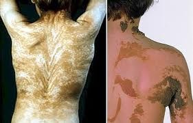 人間の皮膚は肉眼では見えないブラシュコ線で覆われている