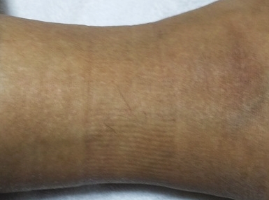 BVDズボン下 足首にゴムの跡が残る