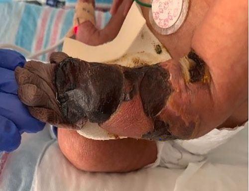 新型コロナの胎内感染で胎児の腕が壊死していた