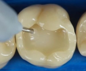 合成樹脂を埋めた臼歯は虫歯治療の痕跡がわからない