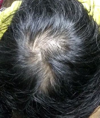 ミノキシジルを5年7ヶ月使ってみた