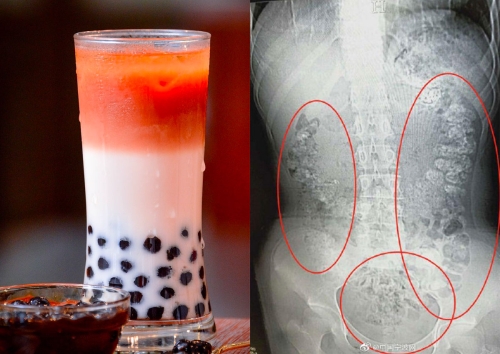 タピオカを食べて5日間も便秘になった少女